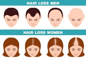 How to Choose the Best Hair Transplant Clinic in Delhi