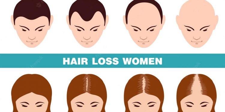 How to Choose the Best Hair Transplant Clinic in Delhi