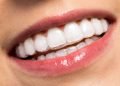 Everything You Should Know About The Invisalign Process