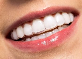 Everything You Should Know About The Invisalign Process
