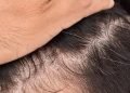DHT Blockers on Managing Hair Loss