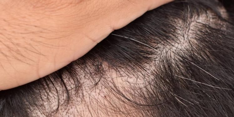 DHT Blockers on Managing Hair Loss