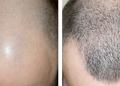 FUE Hair Transplant Unlocking the Must Know Things