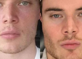 Should-Teenagers-Try-Mewing