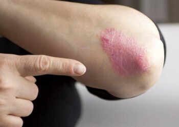 Treating the root cause of psoriasis