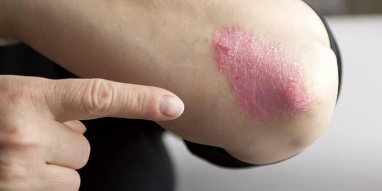 Treating the root cause of psoriasis