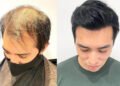 Choosing the Perfect Hair System