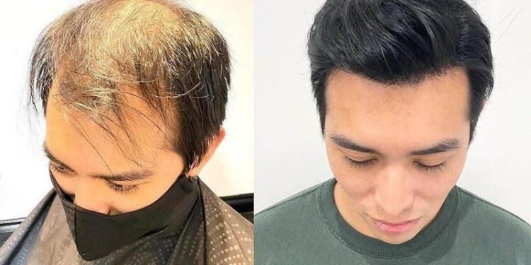 Choosing the Perfect Hair System
