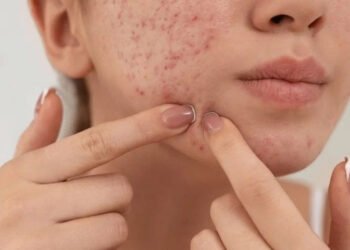 Get Rid of Facial Blemishes