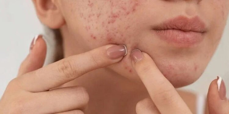 Get Rid of Facial Blemishes