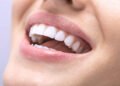 Philips Zoom Teeth Whitening