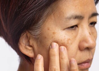 Melasma Treatment