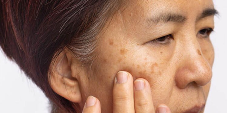 Melasma Treatment