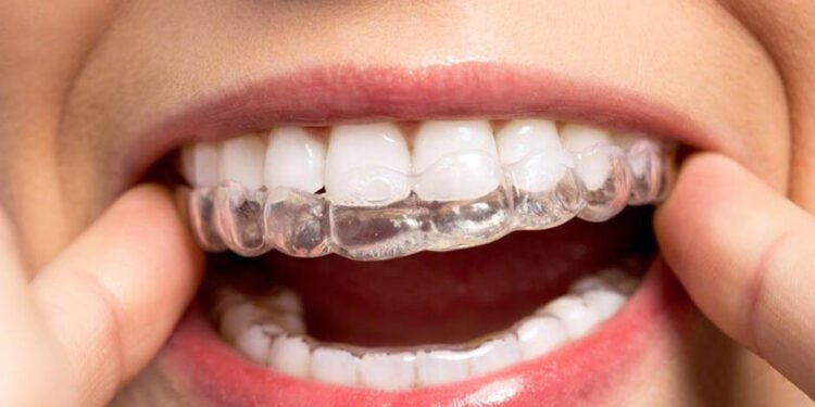 Navigating Invisalign Costs in Winnipeg