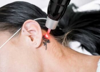 Tattoo Removal Toronto
