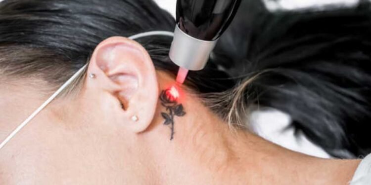 Tattoo Removal Toronto
