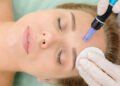 Microneedling