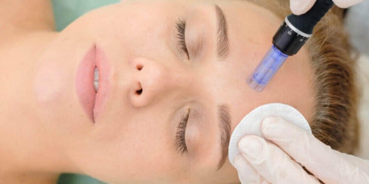 Microneedling