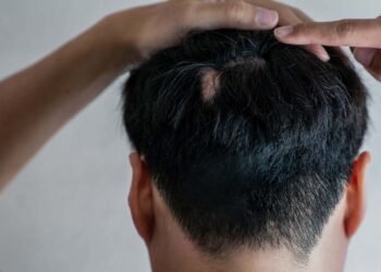 Trichotillomania Hair Regrowth