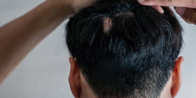 Trichotillomania Hair Regrowth