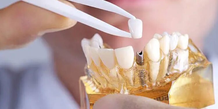 Dental Implants Are Revolutionizing
