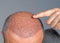 Hair Transplants