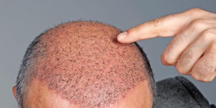 Hair Transplants