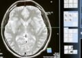 Overcome Anxiety Before Your MRI Scan