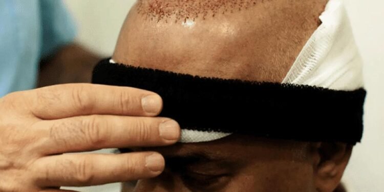 Turkish Hair Transplants