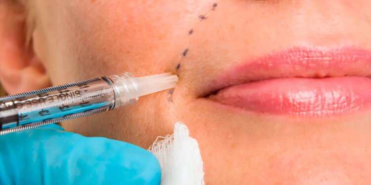 Dermal Fillers