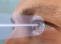 The Benefits of LASIK Surgery