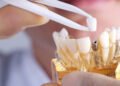 Australians to consider dental implants