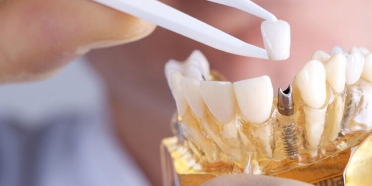 Australians to consider dental implants