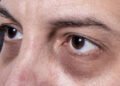 Managing Under-Eye Puffiness
