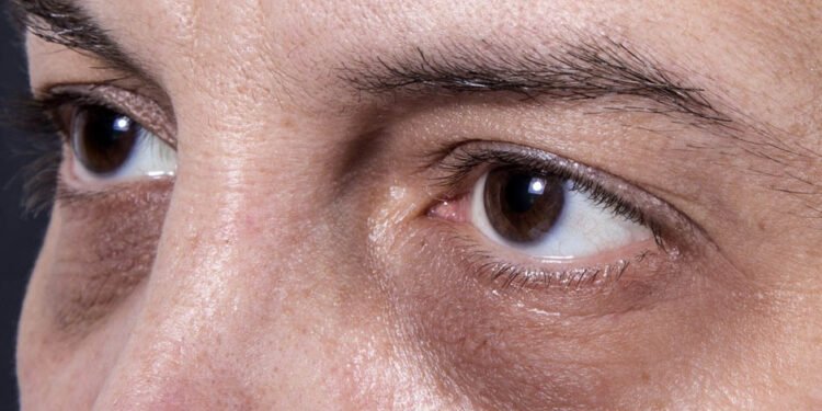 Managing Under-Eye Puffiness