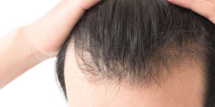 Top Hair Loss Treatment Options in Melbourne 1