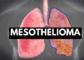 What-You-Should-Know-About-Mesothelioma-Issues
