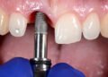 What Makes Dental Implants the Best Tooth Replacement Option