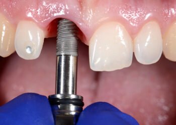 What Makes Dental Implants the Best Tooth Replacement Option