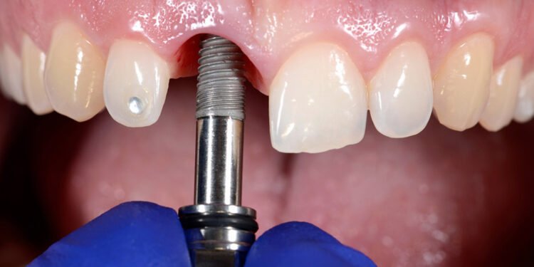 What Makes Dental Implants the Best Tooth Replacement Option
