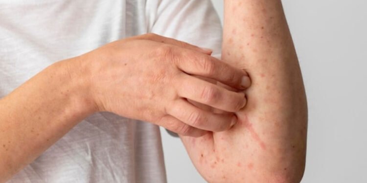 The Discomfort of Chafing Rash: A Closer Look