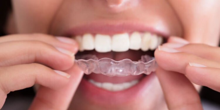 Protecting Your Teeth from Everyday Wear and Tear