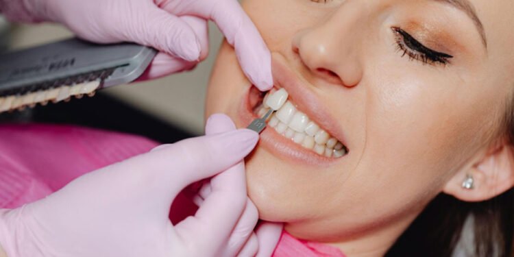 Smile Makeover in Brisbane: Combining Implants and Veneers for Best Results