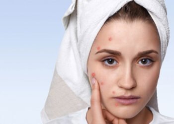 The Dos and Don'ts of Managing Acne