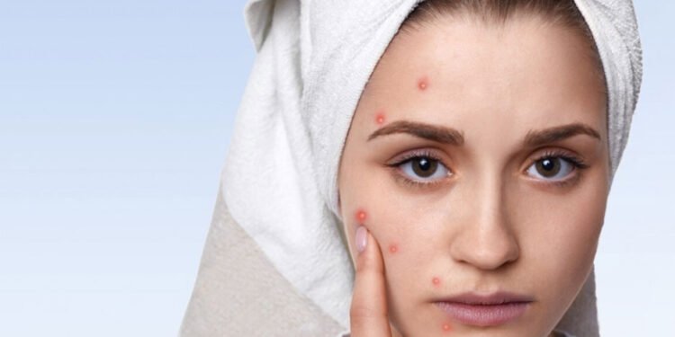 The Dos and Don'ts of Managing Acne