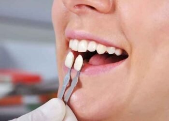 Myths About Veneers Debunked