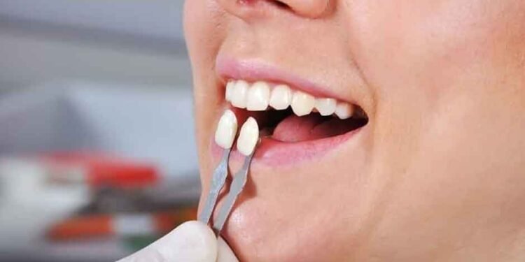 Myths About Veneers Debunked
