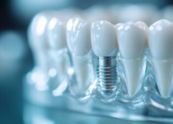 Dental Implants Through the Eyes of a Cosmetic Dentist