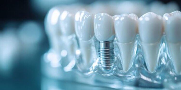 Dental Implants Through the Eyes of a Cosmetic Dentist