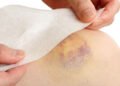 The Little-Known Nutrients That Protect Your Skin From Surgery Bruises